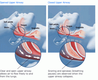 Obstructive sleep Apnea